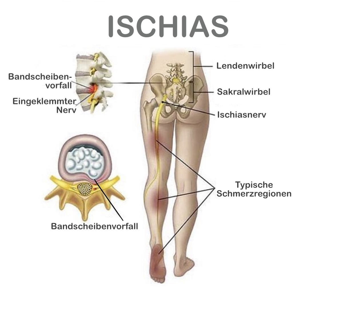 Ischias- oder Piriformis Syndrom?